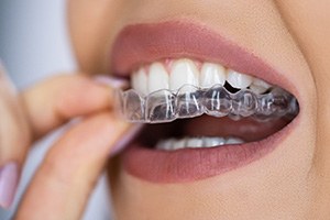 Close-up of woman placing Invisalign on her teeth