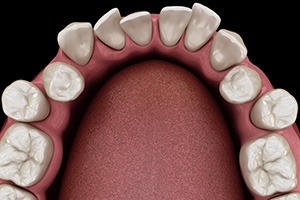 Illustration of crowded teeth viewed from above