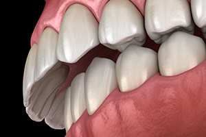 Illustration of an overbite against dark background