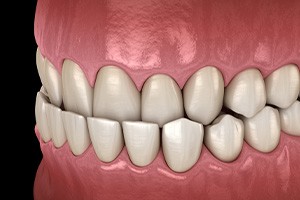 Illustration of an underbite against dark background