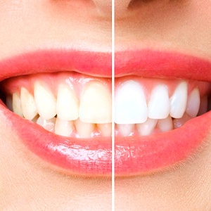 Close-up of woman’s smile before and after teeth whitening