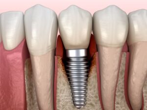 Illustration showing infected tissue around a dental implant