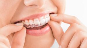 Close-up of woman sliding Invisalign onto her teeth 